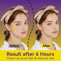 Yellow Star Pimple Patches