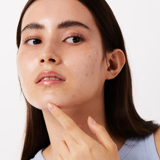 The Complete Guide to Acne Care for Every Skin Type: Finding Your Perfect Patch