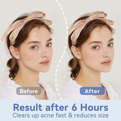 OmaDoto Pimple Patches for Face - 12mm Acne Patches (72 Count) Hydrocolloid Invisible, Day Night Under Makeup Travel