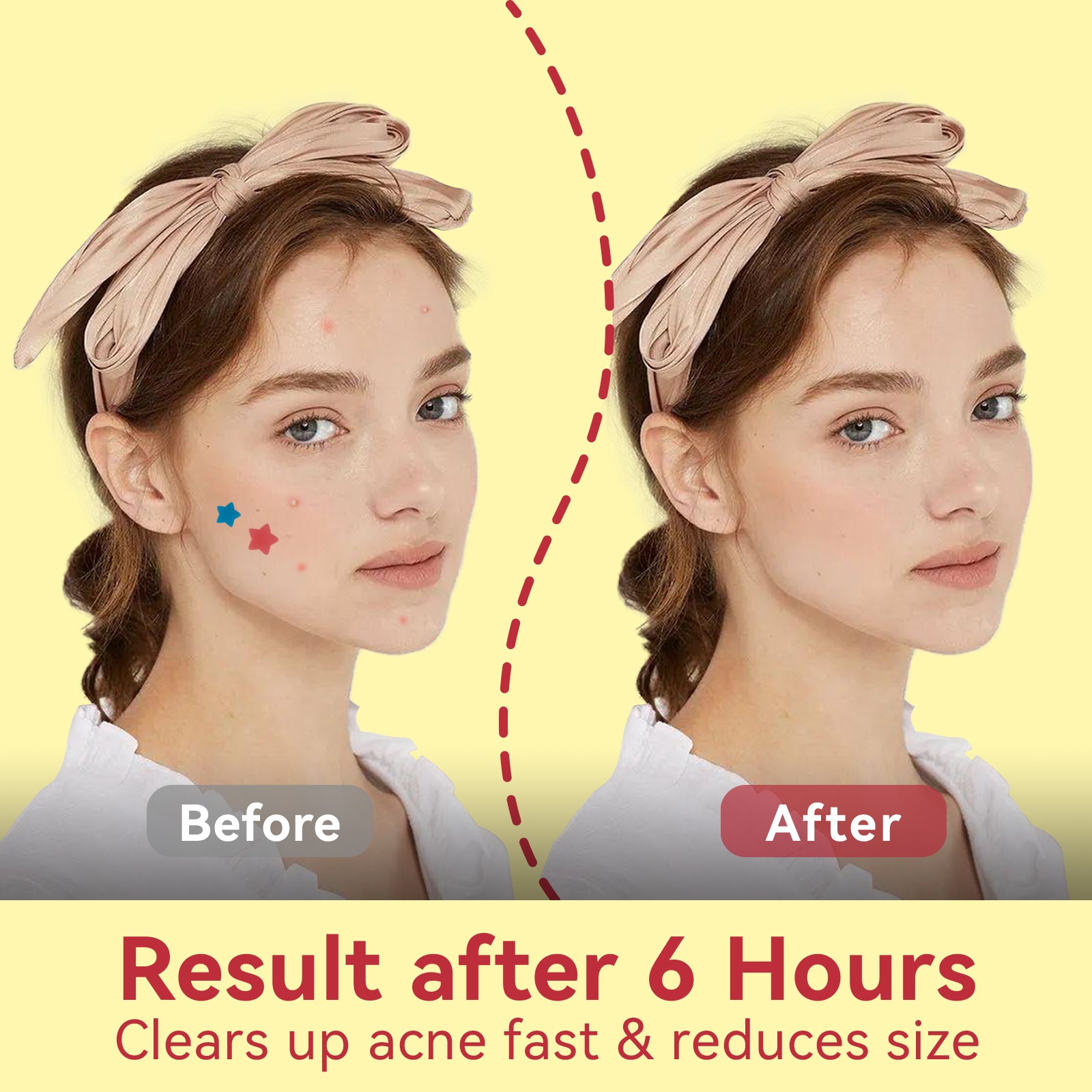 omadoto pimple patches